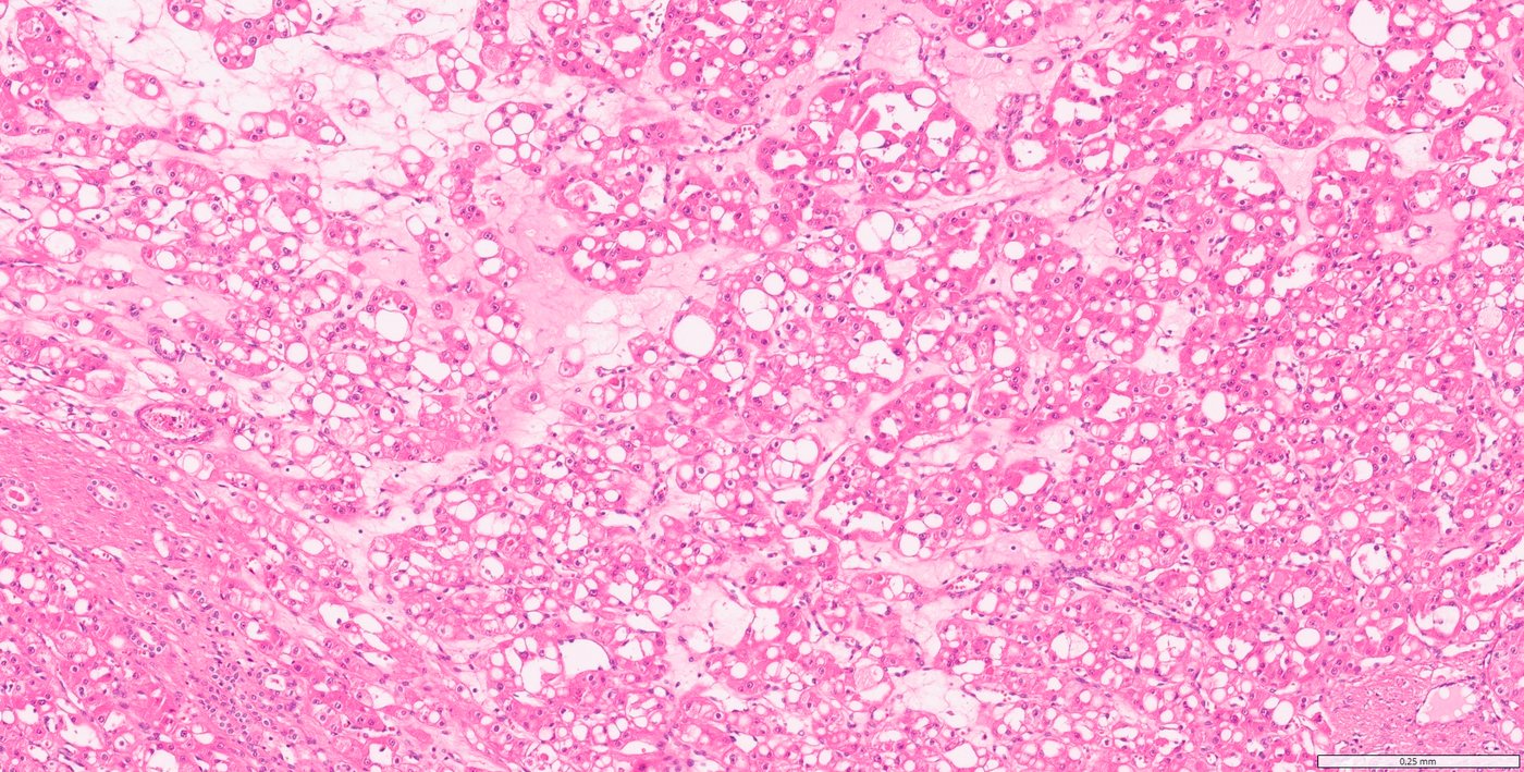 Eosinophilic vacuolated tumour: Vacuolated cells in nests with oedematous stroma