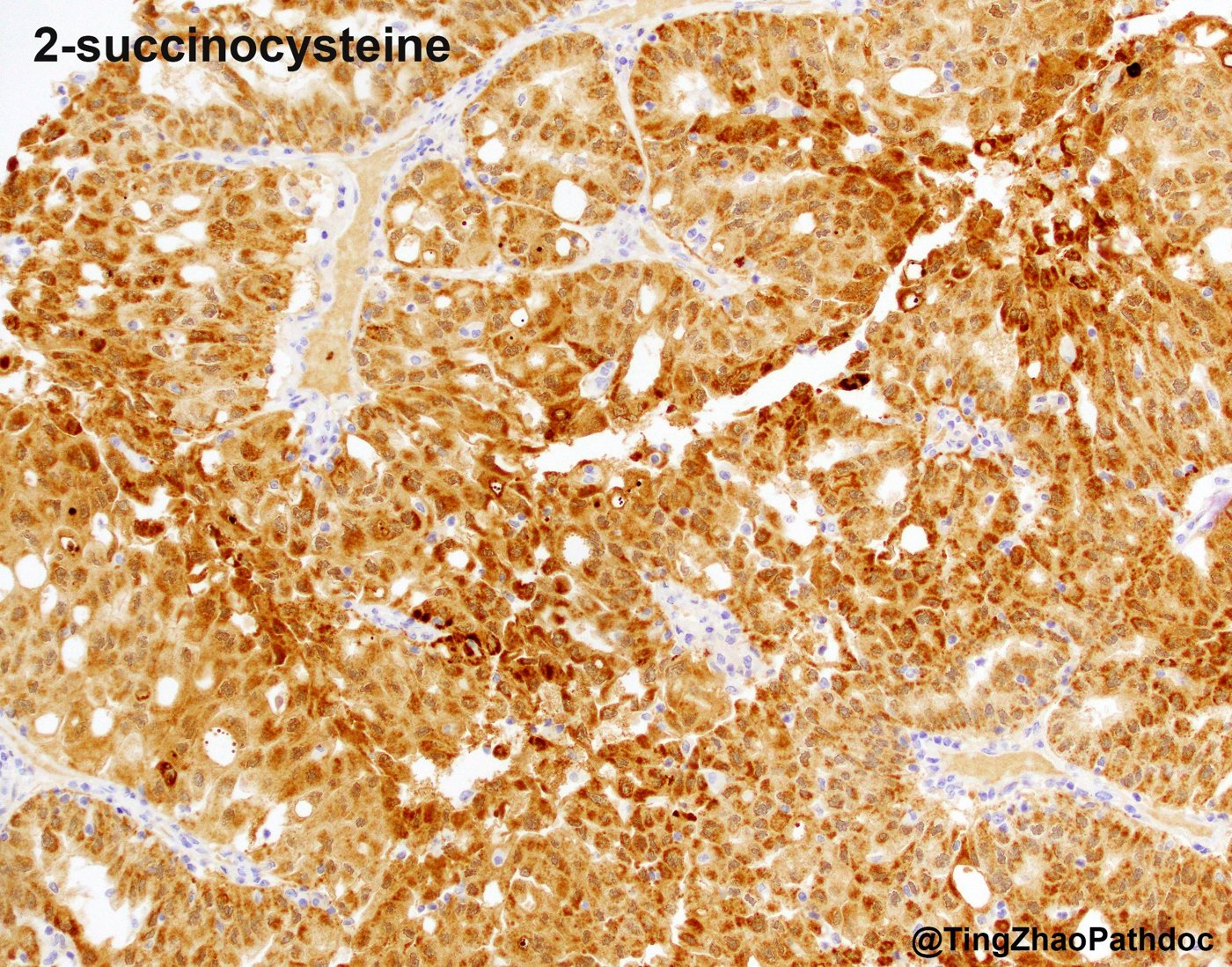 Fumarate hydratase-deficient renal cell carcinoma: 2-succinocysteine (2SC): diffuse strong nuclear and cytoplasmic positivity