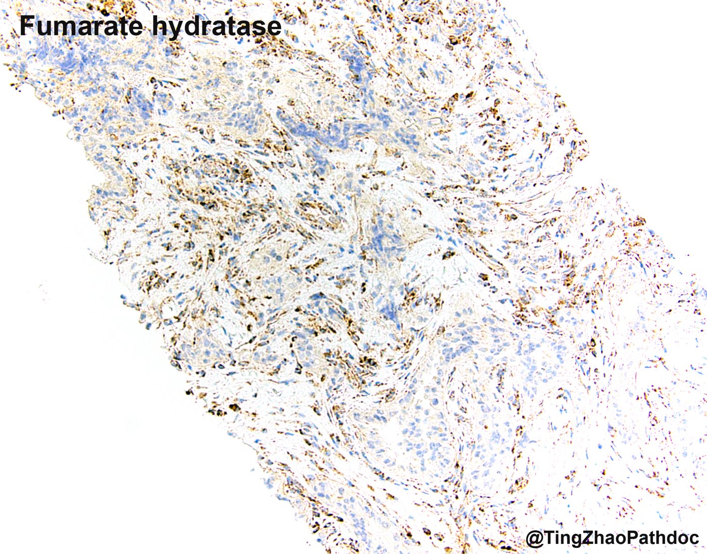 Fumarate hydratase-deficient renal cell carcinoma: FH on the same biopsy: tumour cells negative, stromal and inflammatory cells positive