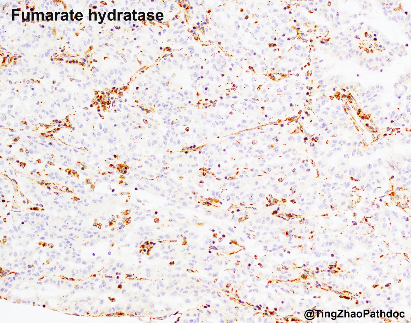 Fumarate hydratase-deficient renal cell carcinoma: FH: complete loss in tumour cells with retained internal controls