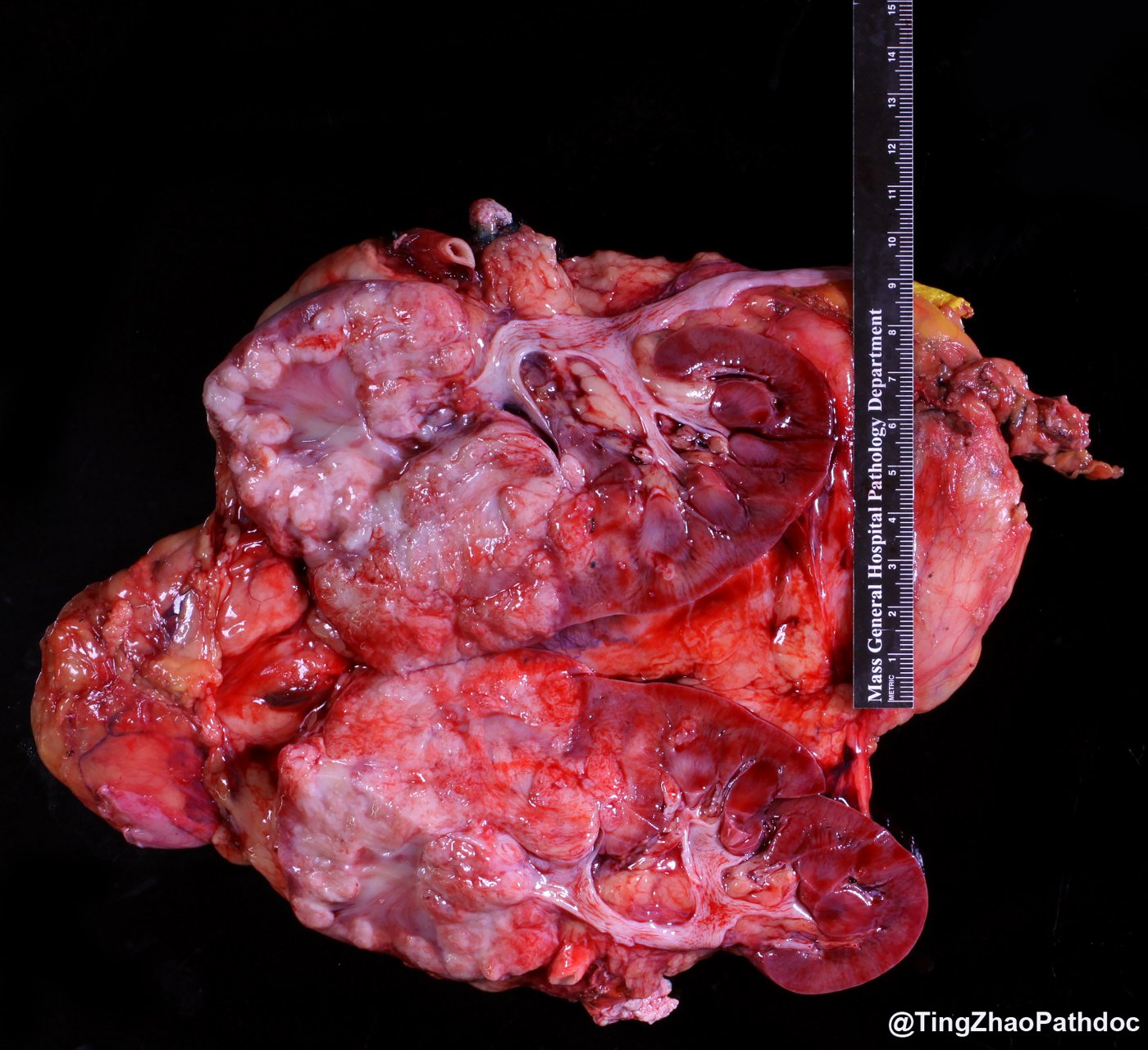 Fumarate hydratase-deficient renal cell carcinoma: Gross: large, pale, infiltrative tumour replacing the kidney and extending into the sinus