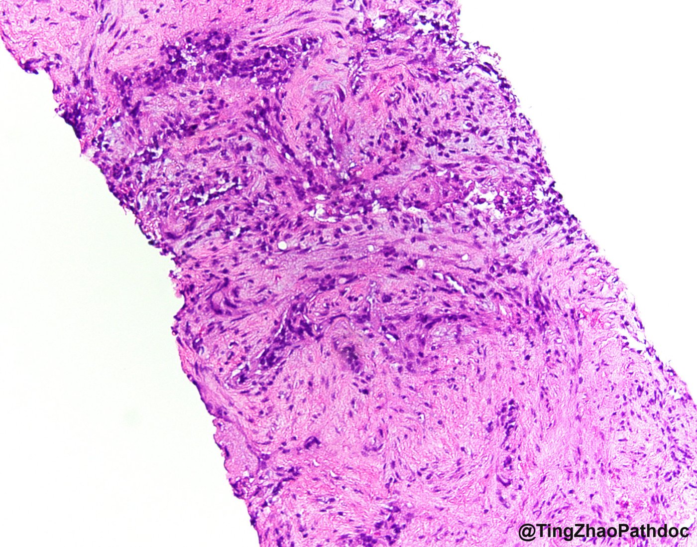 Fumarate hydratase-deficient renal cell carcinoma: Core biopsy: infiltrative cords and glands in desmoplastic stroma
