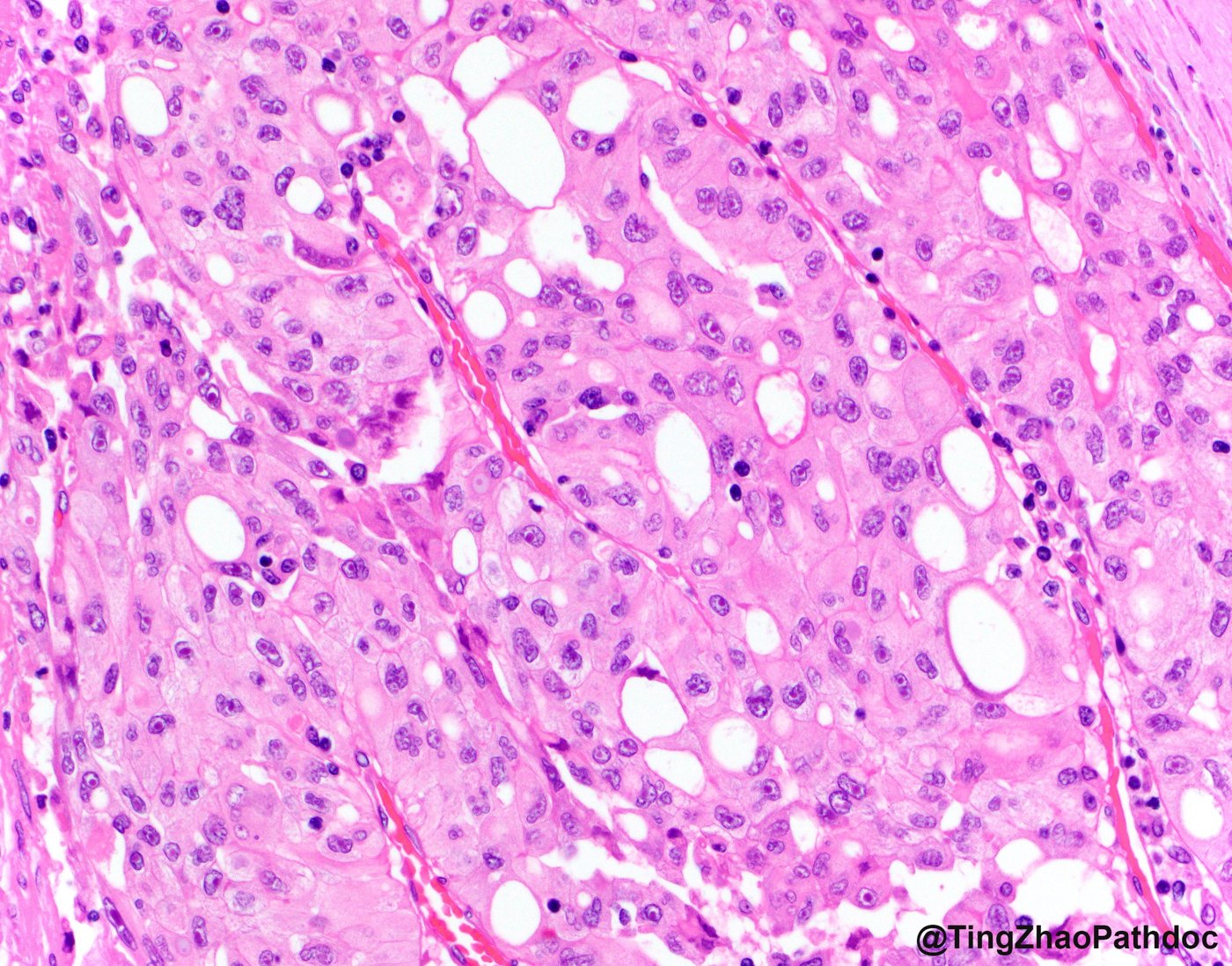 Fumarate hydratase-deficient renal cell carcinoma: Cribriform nests with vacuoles and prominent nucleoli
