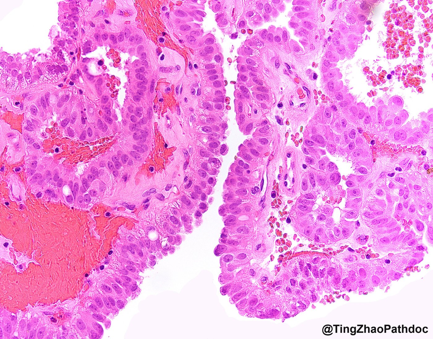 Fumarate hydratase-deficient renal cell carcinoma: High power: columnar cells with large eosinophilic nucleoli