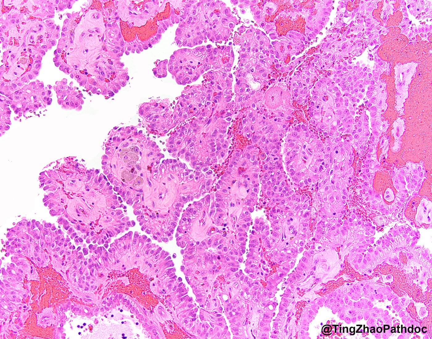 Fumarate hydratase-deficient renal cell carcinoma: Papillae with hyalinised cores, haemorrhage and pigmented macrophages