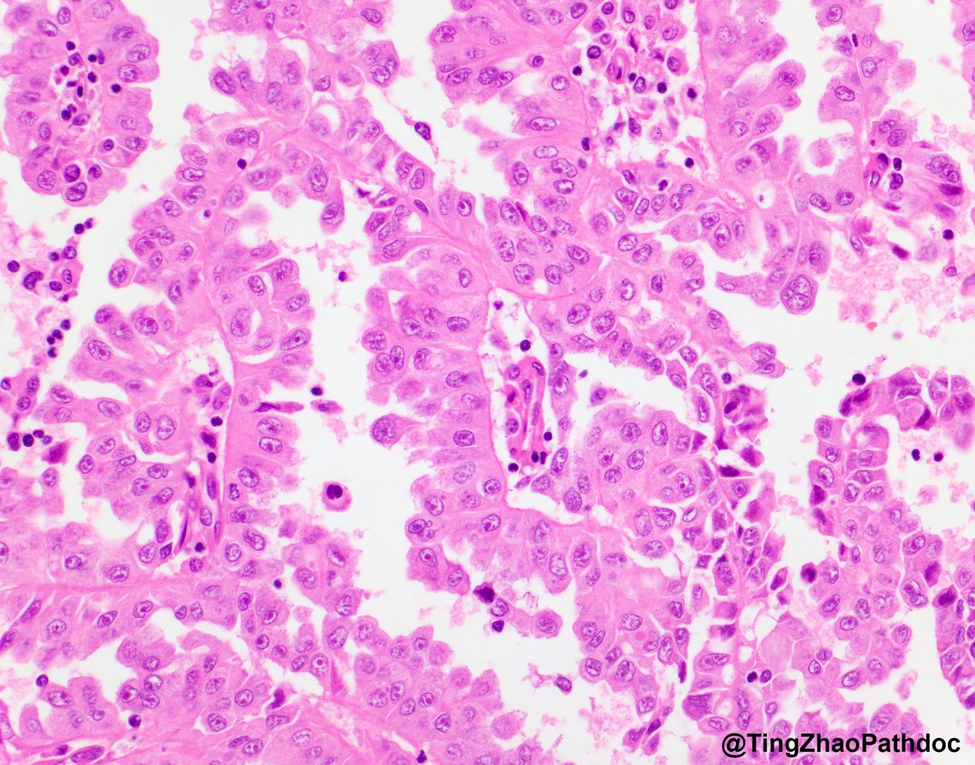 Fumarate hydratase-deficient renal cell carcinoma: Papillae lined by cells with cherry-red macronucleoli and halos