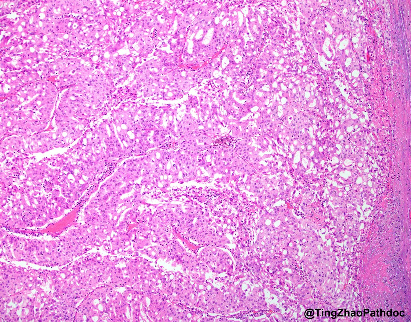 Fumarate hydratase-deficient renal cell carcinoma: Solid and sieve-like areas with many small lumina