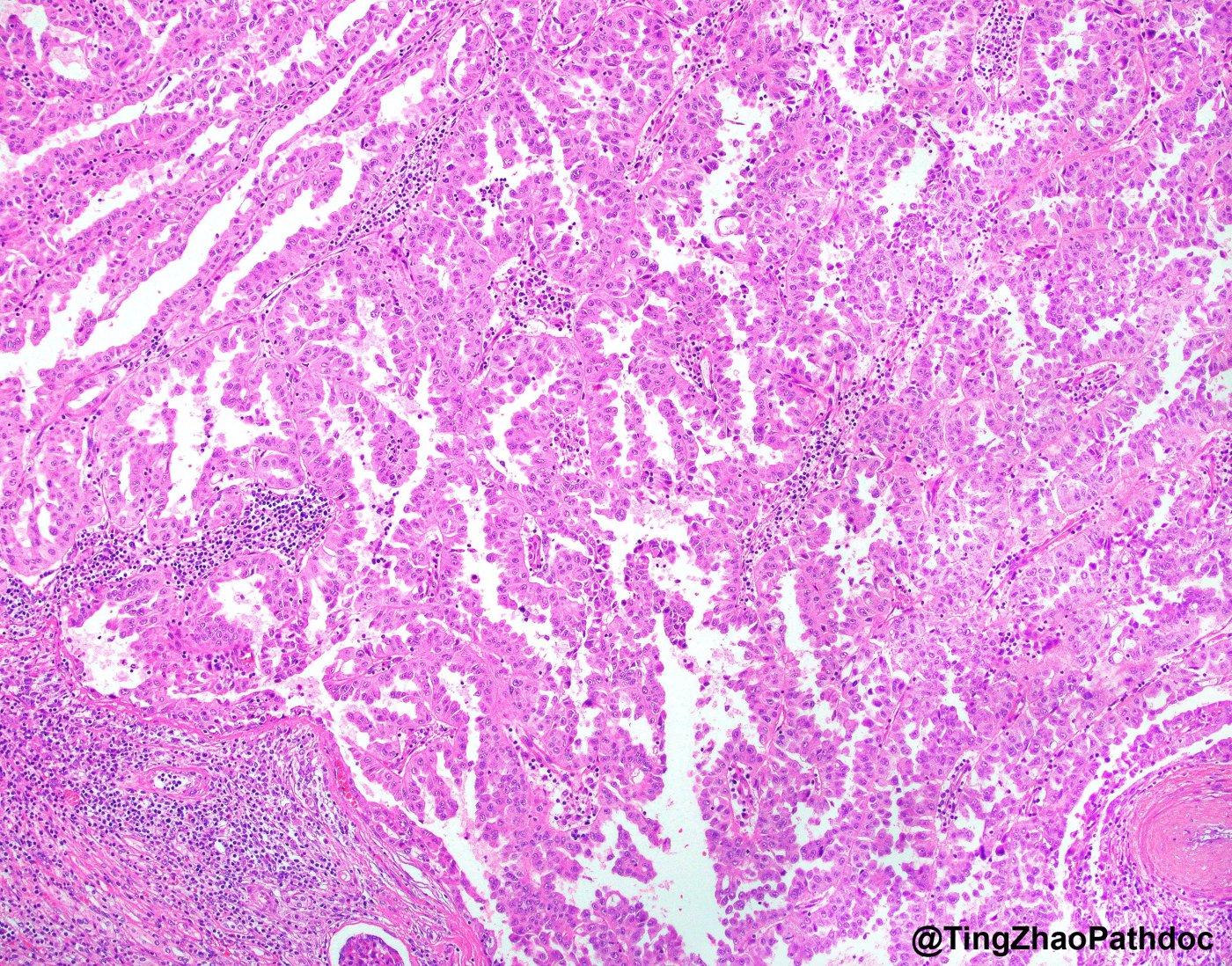 Fumarate hydratase-deficient renal cell carcinoma: Low power: papillary and tubulopapillary growth of eosinophilic cells