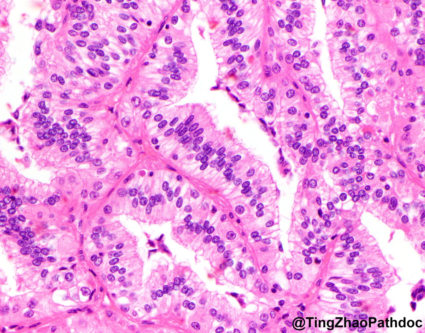 FLCN-mutated renal neoplasms: Germline (BHD) case, high power: columnar pale cells with stratified nuclei