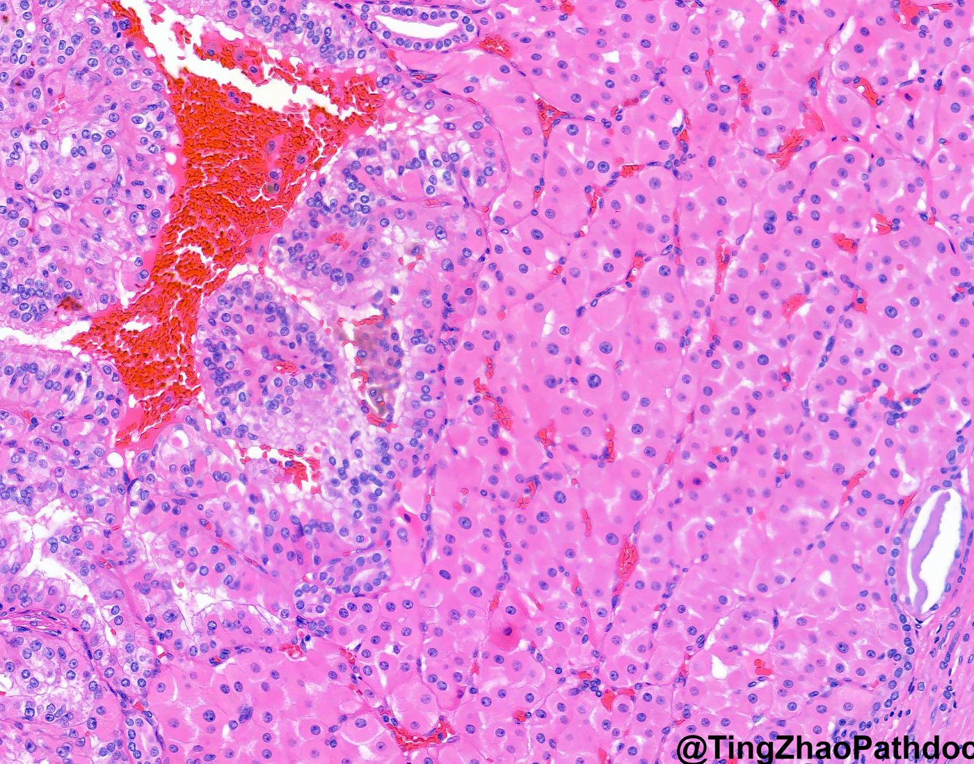 FLCN-mutated renal neoplasms: Germline (BHD) case: pale tumour cells beside an eosinophilic oncocytic population