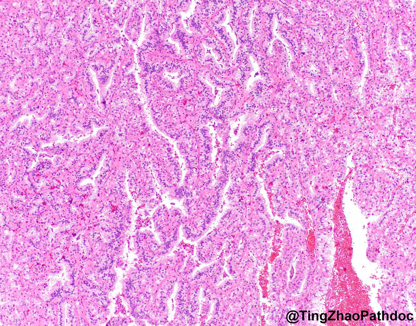 FLCN-mutated renal neoplasms: Germline (BHD) case, low power: tubulopapillary growth with pale cells