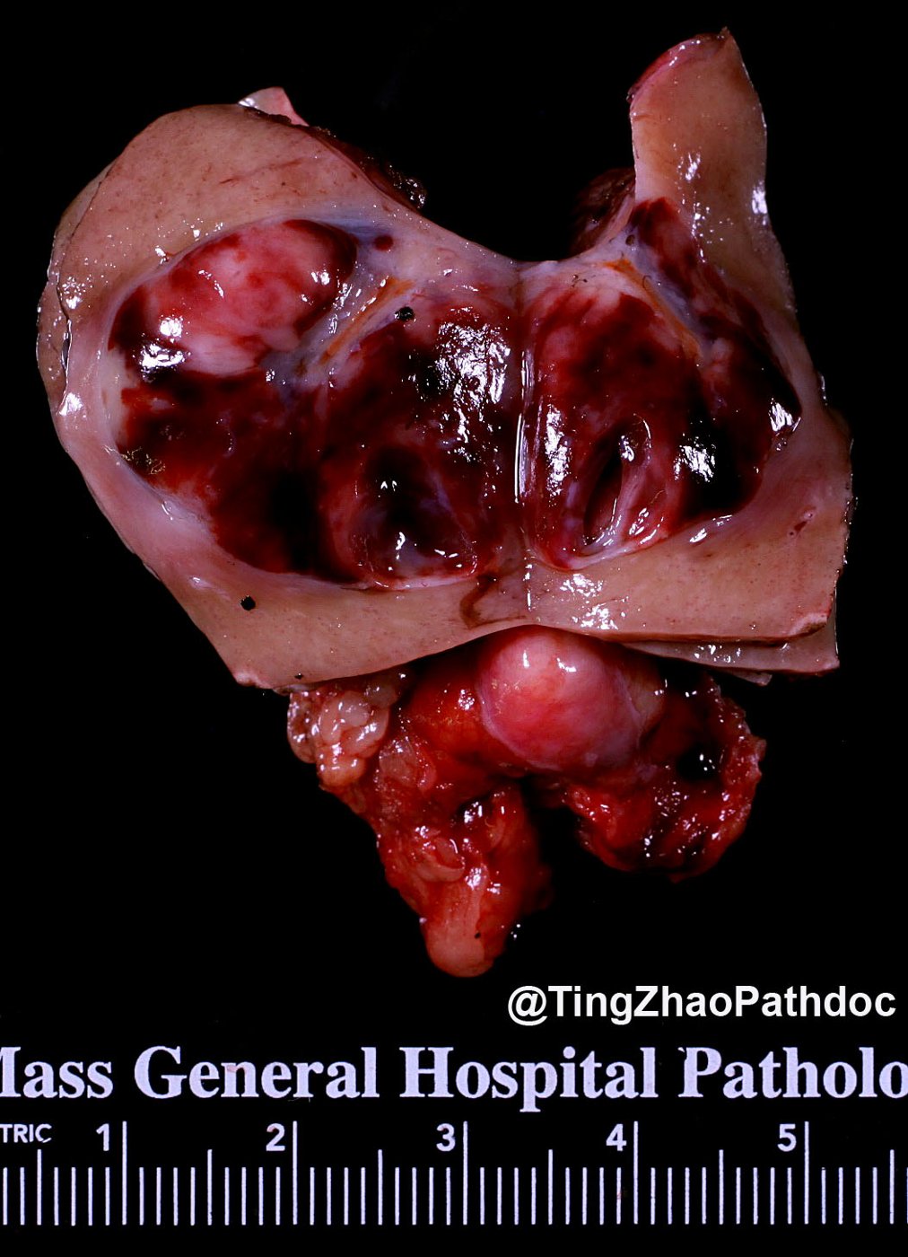 Juxtaglomerular cell tumour: Gross: circumscribed haemorrhagic cortical nodule