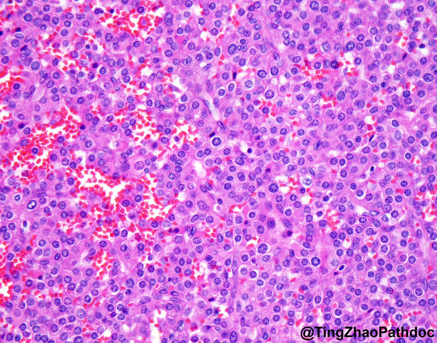 Juxtaglomerular cell tumour: H&E high power: bland round nuclei and pale eosinophilic cytoplasm