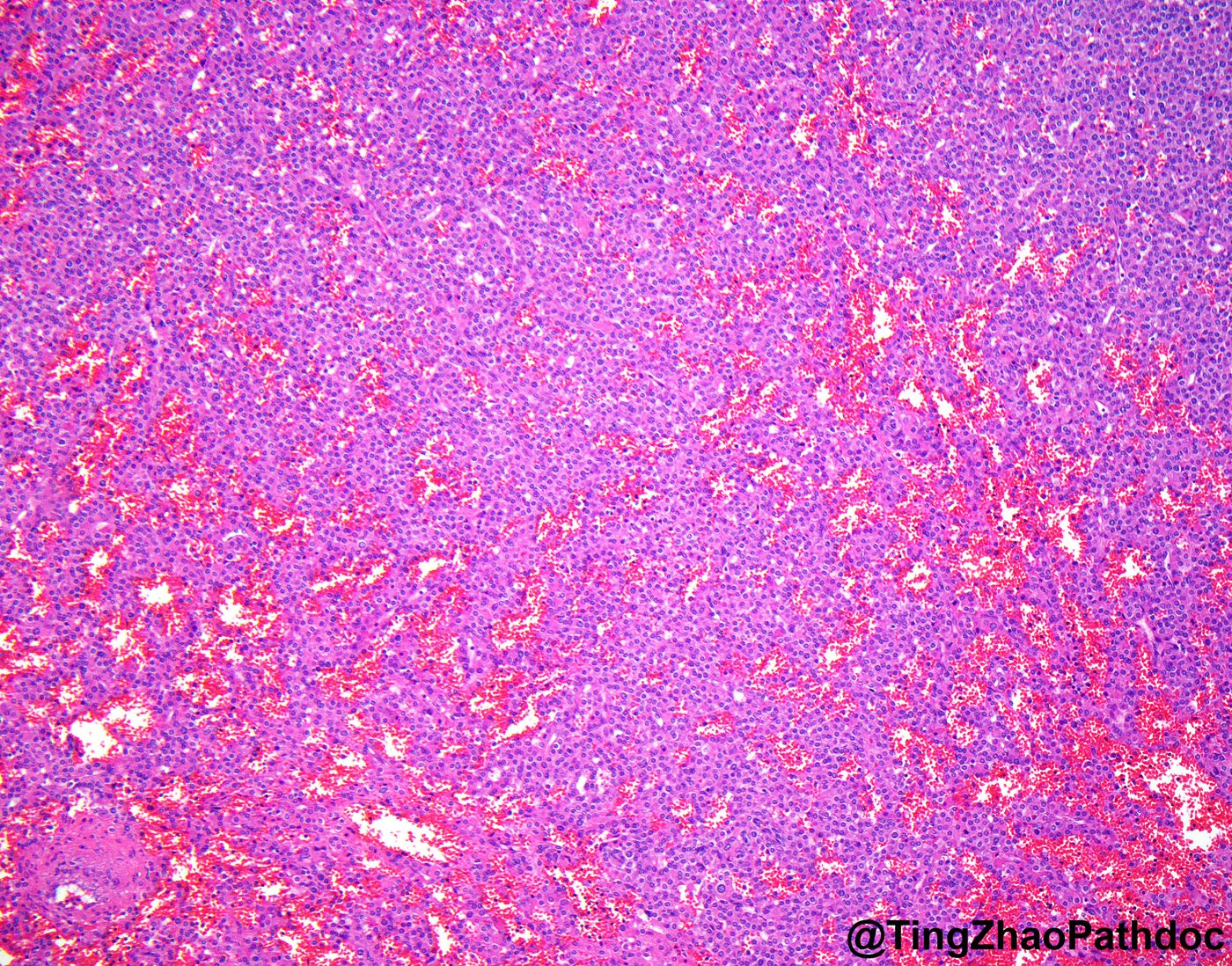 Juxtaglomerular cell tumour: H&E low power: solid sheets with ectatic blood-filled vessels