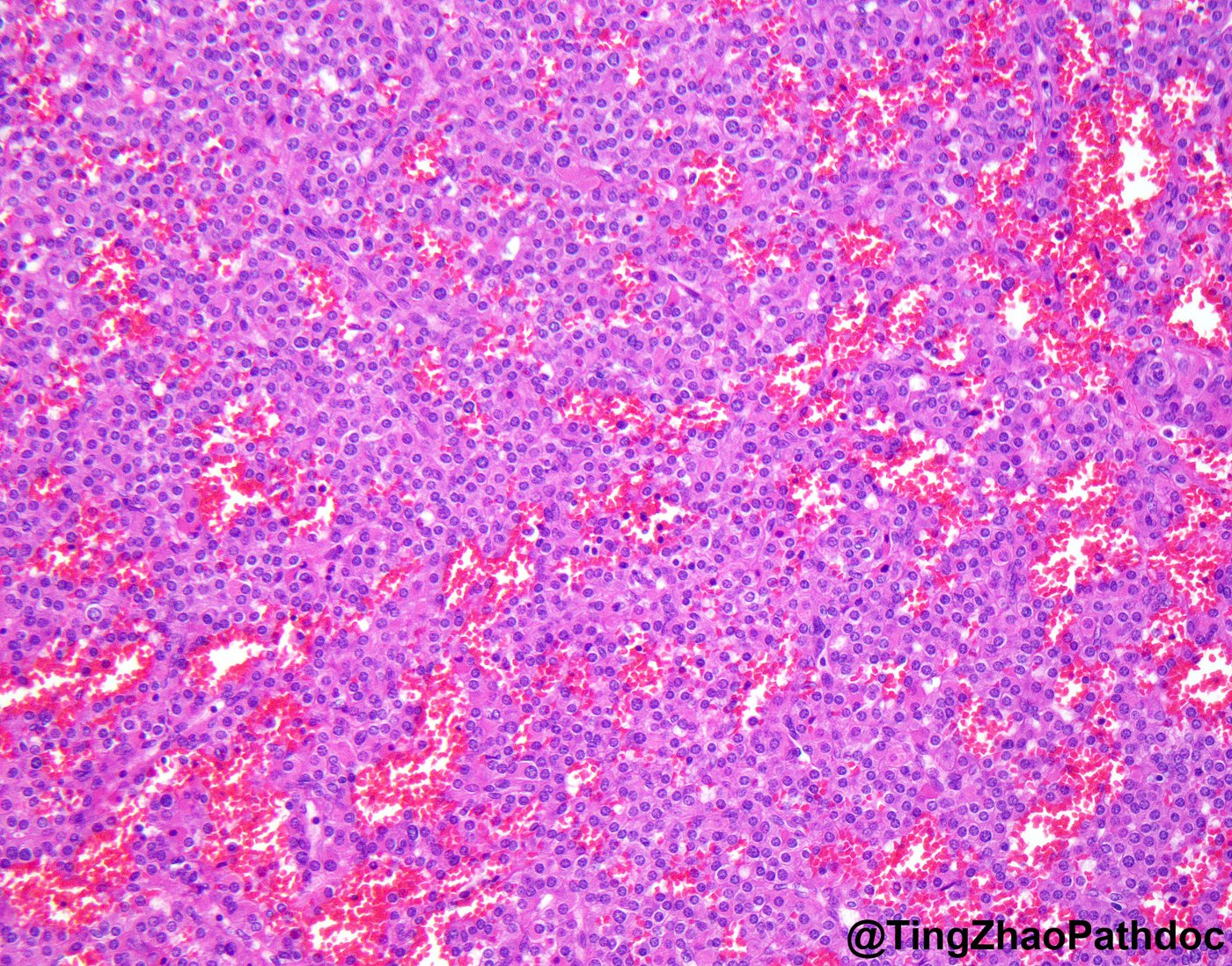 Juxtaglomerular cell tumour: H&E medium power: uniform glomoid cells around thin-walled vessels
