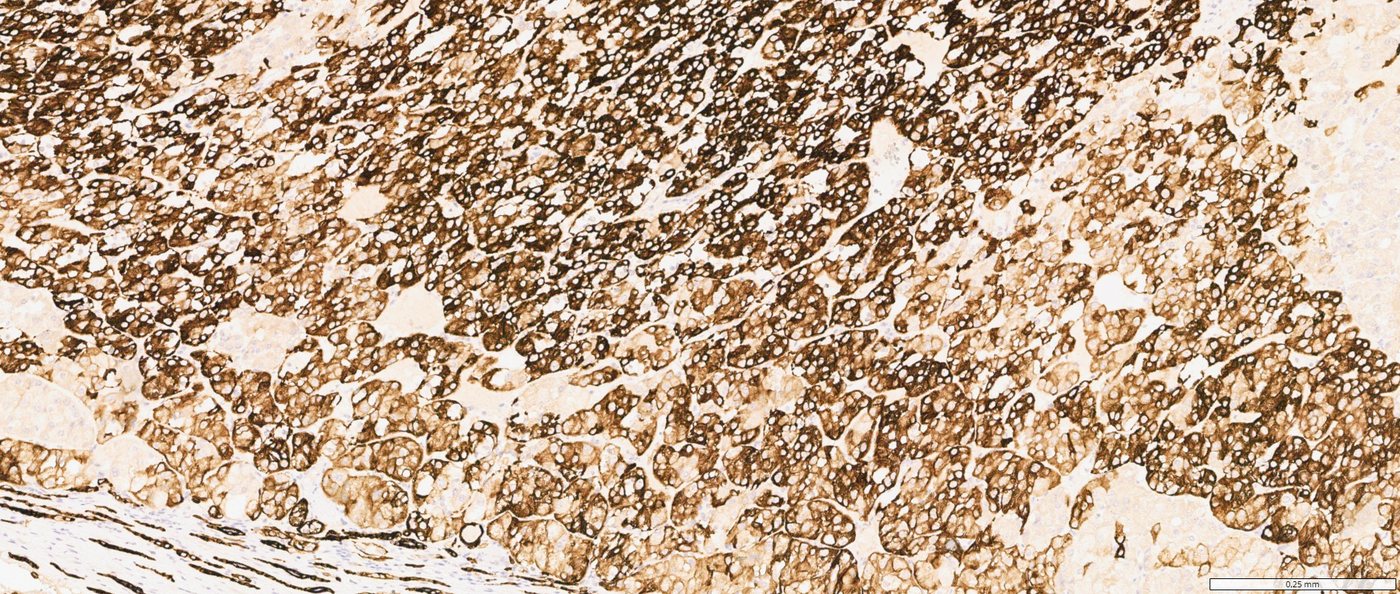Low-grade oncocytic tumour — CK7: strong, diffuse