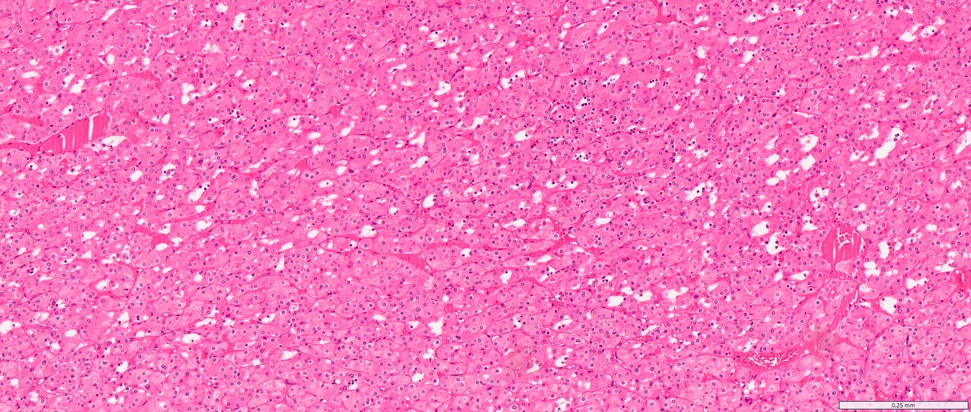 Low-grade oncocytic tumour — Compact nests of bland oncocytic cells with perinuclear halos