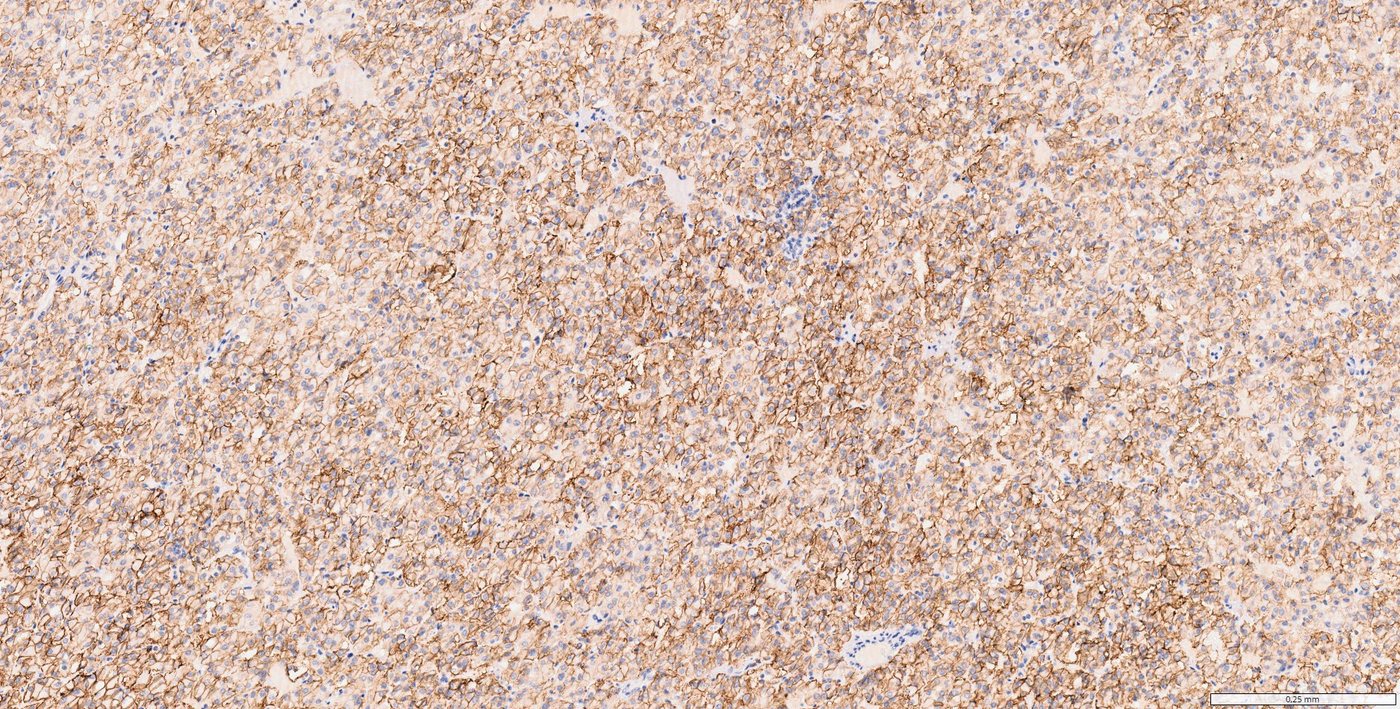 Low-grade oncocytic tumour — Diffuse membranous immunostaining