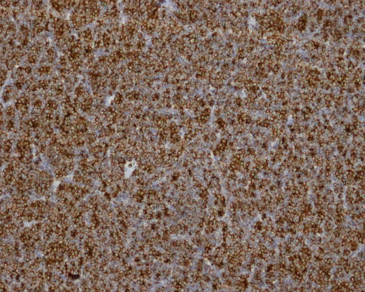 Metanephric adenoma: BRAF V600E (VE1): diffuse cytoplasmic positivity