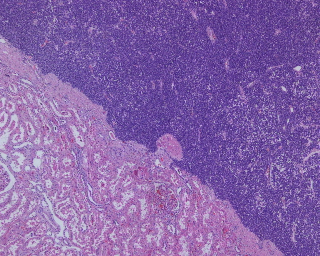 Metanephric adenoma: Low power: densely cellular basophilic tumour abutting kidney without a capsule
