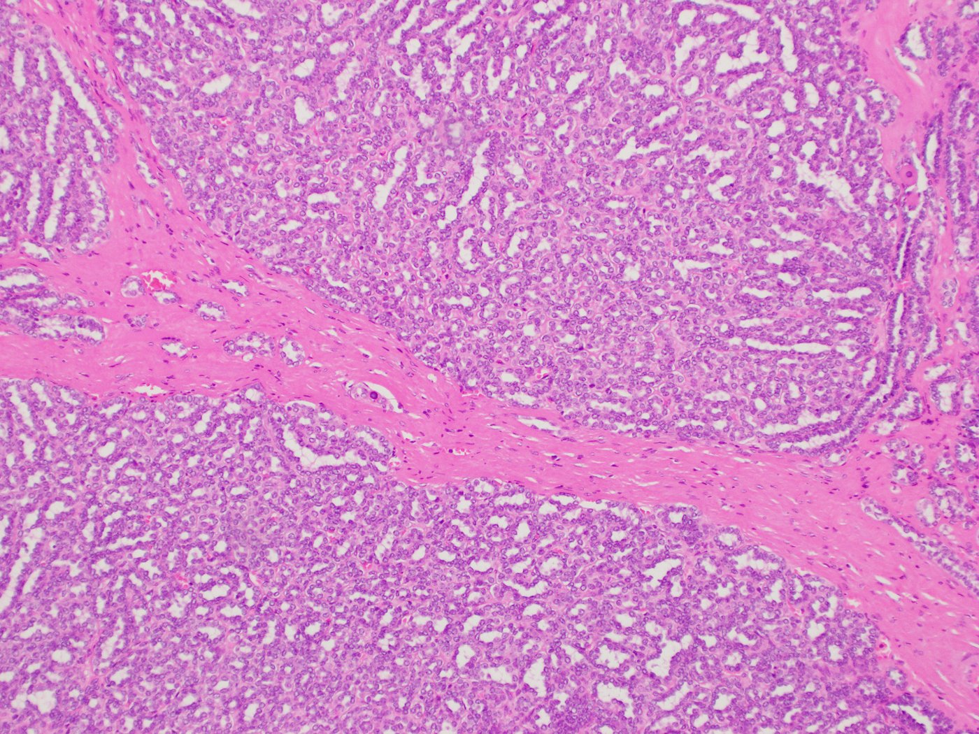 Metanephric adenoma: Lobules of packed tubules divided by fibrous septa, with elongated branching tubules at the edges