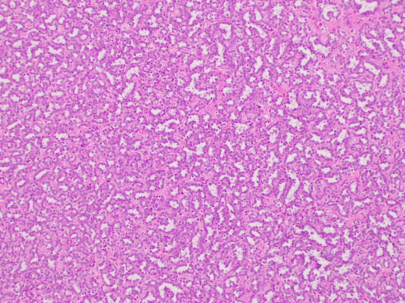 Metanephric adenoma: Densely packed small acini and tubules of uniform cells