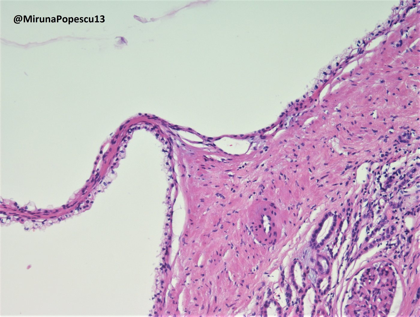 Multilocular cystic renal neoplasm of low malignant potential — Cyst lined by a single layer of low-grade clear cells; thin fibrous septum and adjacent kidney