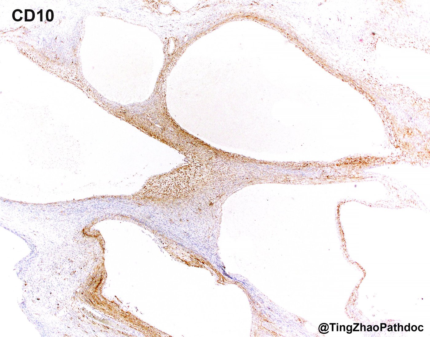 Mixed epithelial and stromal tumour and cystic nephroma: CD10: positive in the stroma
