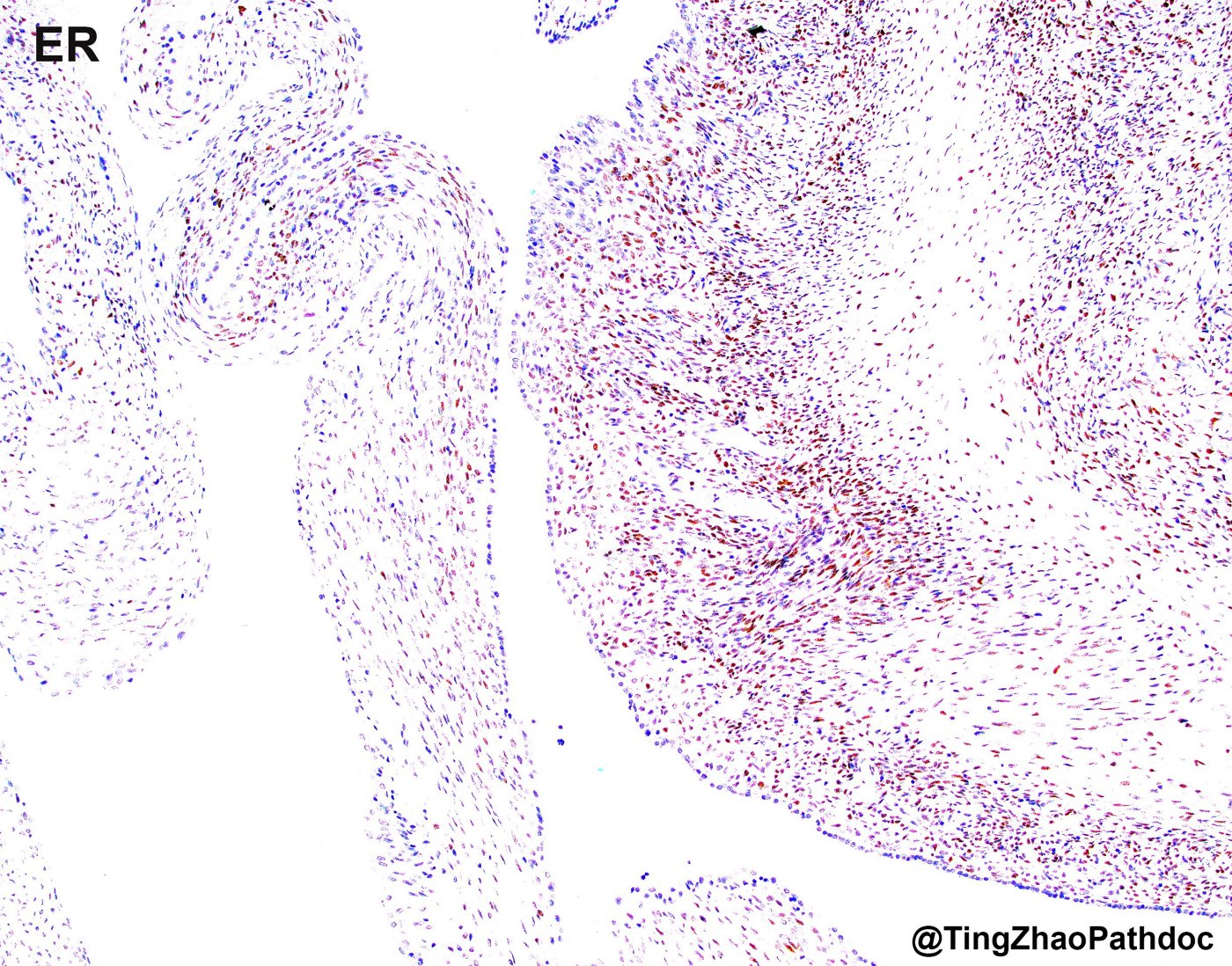 Mixed epithelial and stromal tumour and cystic nephroma: ER: nuclear positivity in the stroma