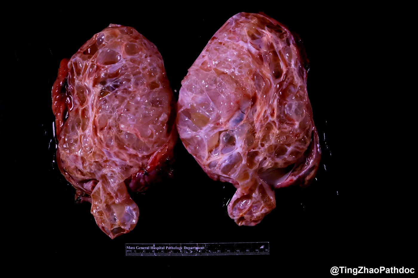 Mixed epithelial and stromal tumour and cystic nephroma: Gross: multilocular cystic tumour with a polypoid protrusion