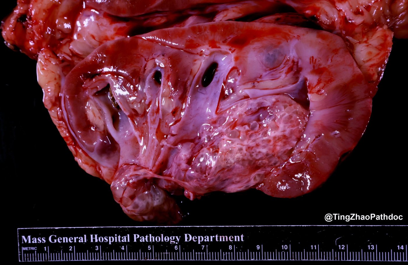 Mixed epithelial and stromal tumour and cystic nephroma: Gross: multicystic mass centred in the renal sinus