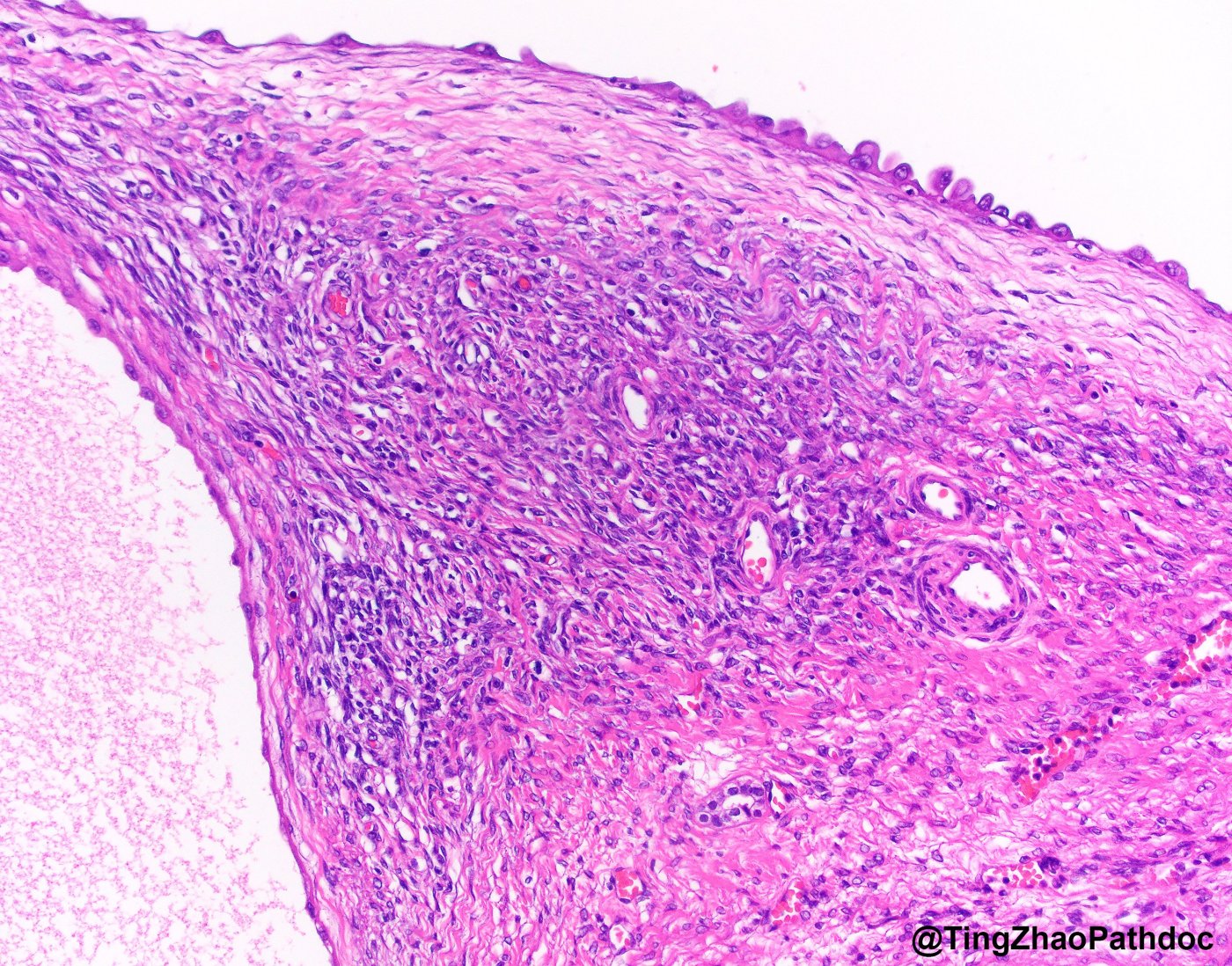 Mixed epithelial and stromal tumour and cystic nephroma: H&E high power: hobnail lining and cellular stroma