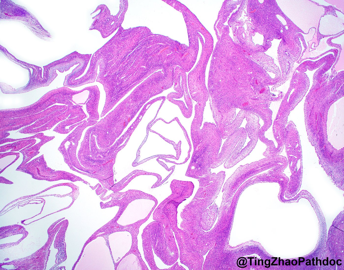 Mixed epithelial and stromal tumour and cystic nephroma: H&E low power: cysts in cellular stroma