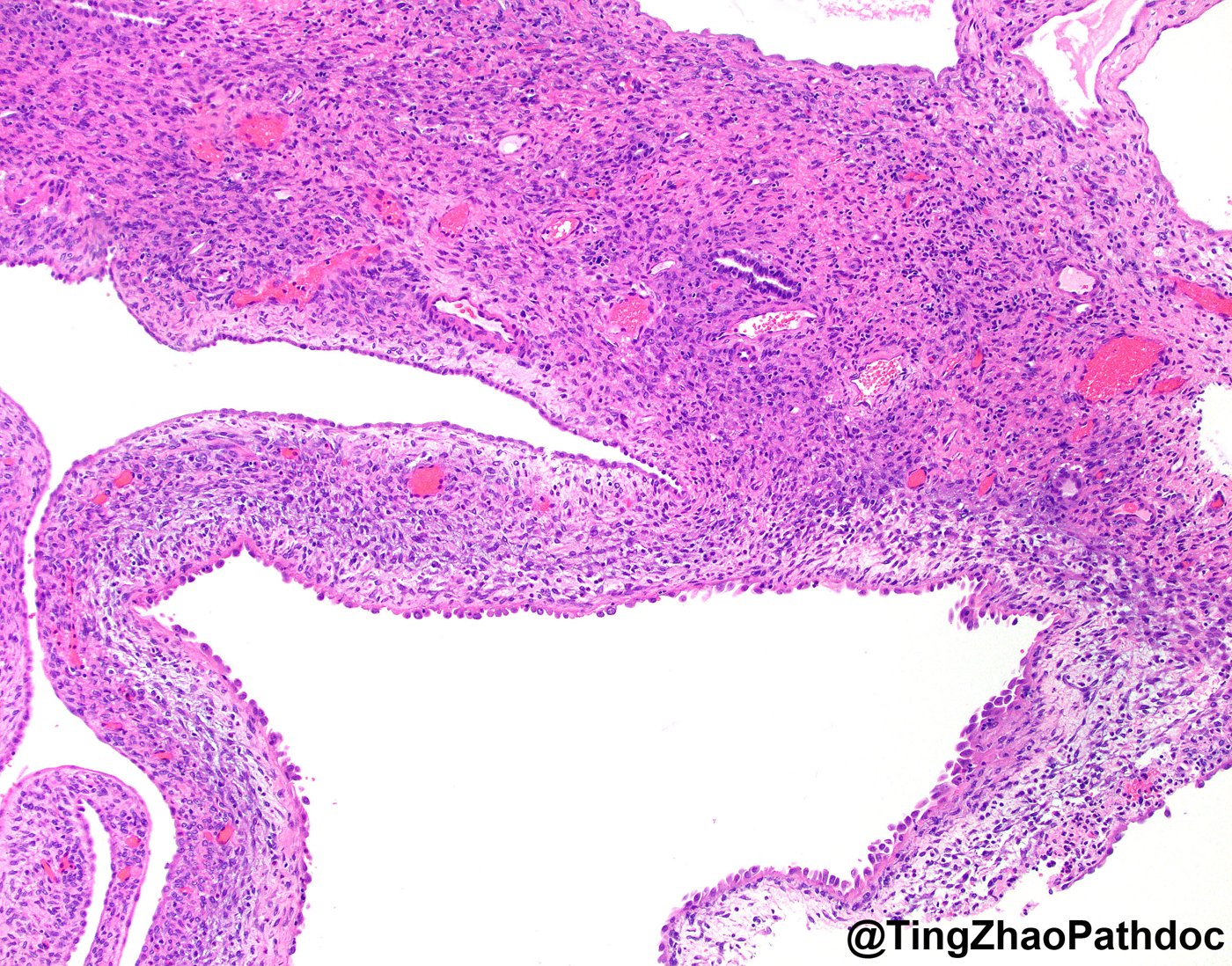 Mixed epithelial and stromal tumour and cystic nephroma: H&E: ovarian-type stroma around cysts and small tubules