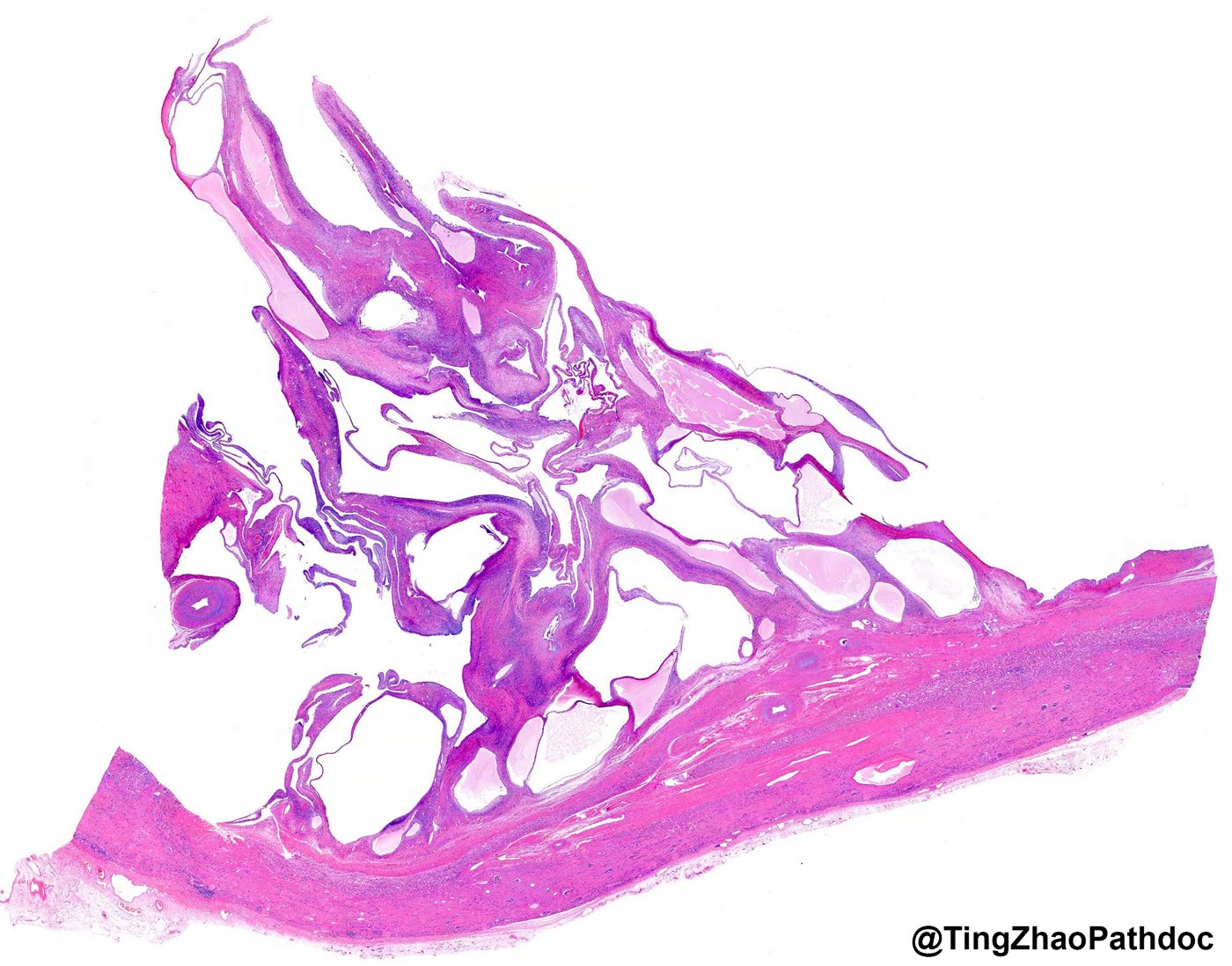 Mixed epithelial and stromal tumour and cystic nephroma: Whole mount: cysts and stroma above the renal pelvic wall