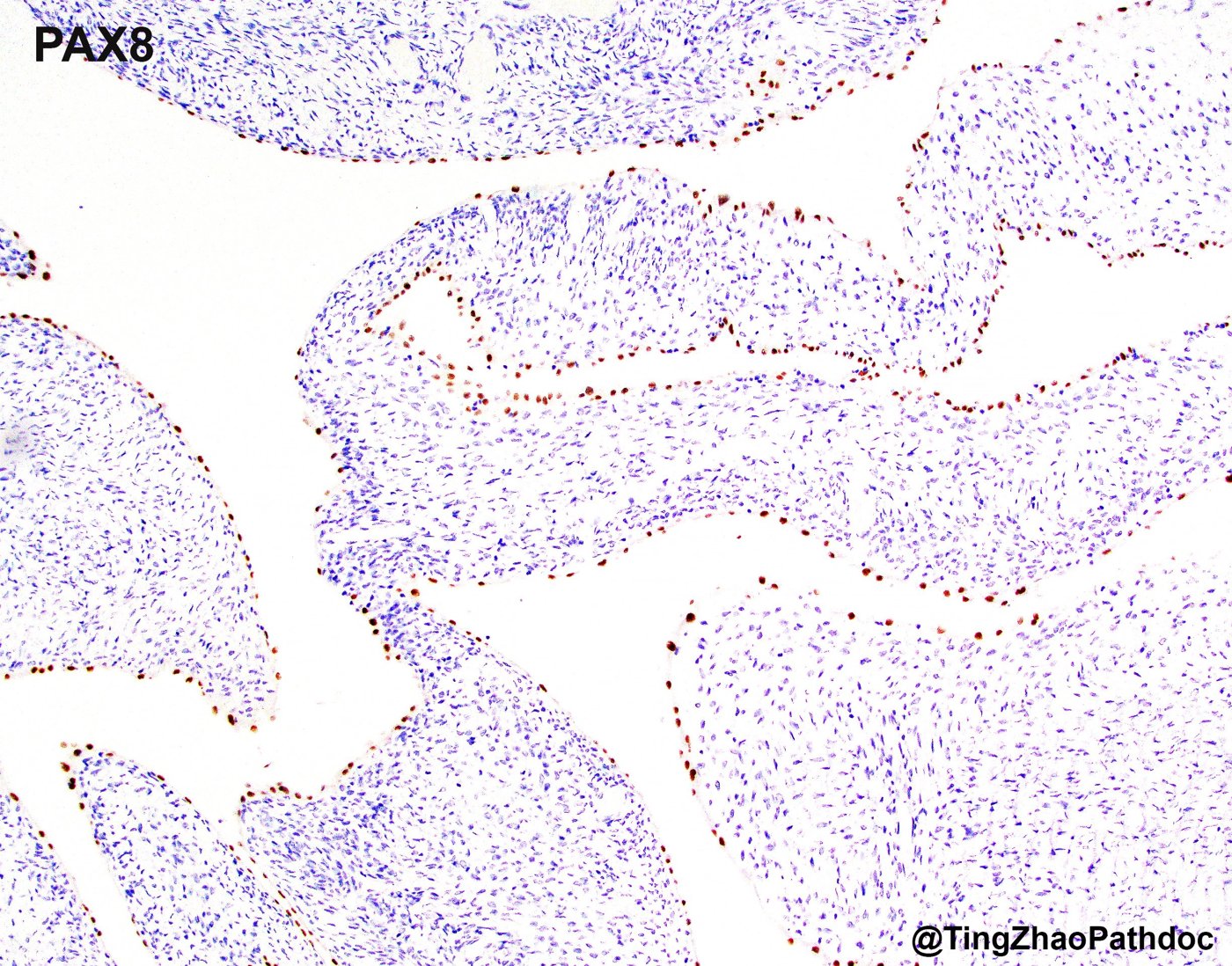 Mixed epithelial and stromal tumour and cystic nephroma: PAX8: positive in the epithelial lining