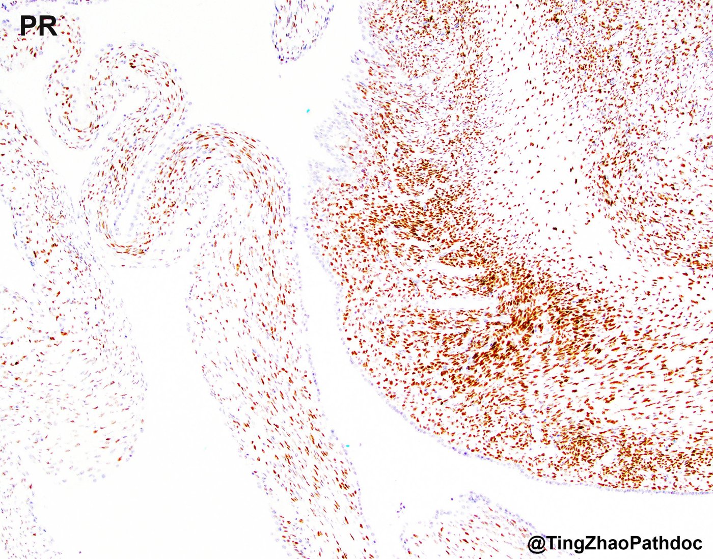 Mixed epithelial and stromal tumour and cystic nephroma: PR: strong diffuse stromal positivity