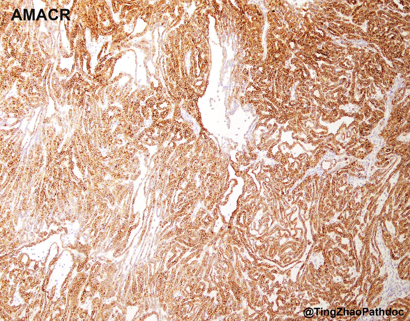 Mucinous tubular and spindle cell carcinoma: AMACR (P504S): diffuse granular cytoplasmic positivity