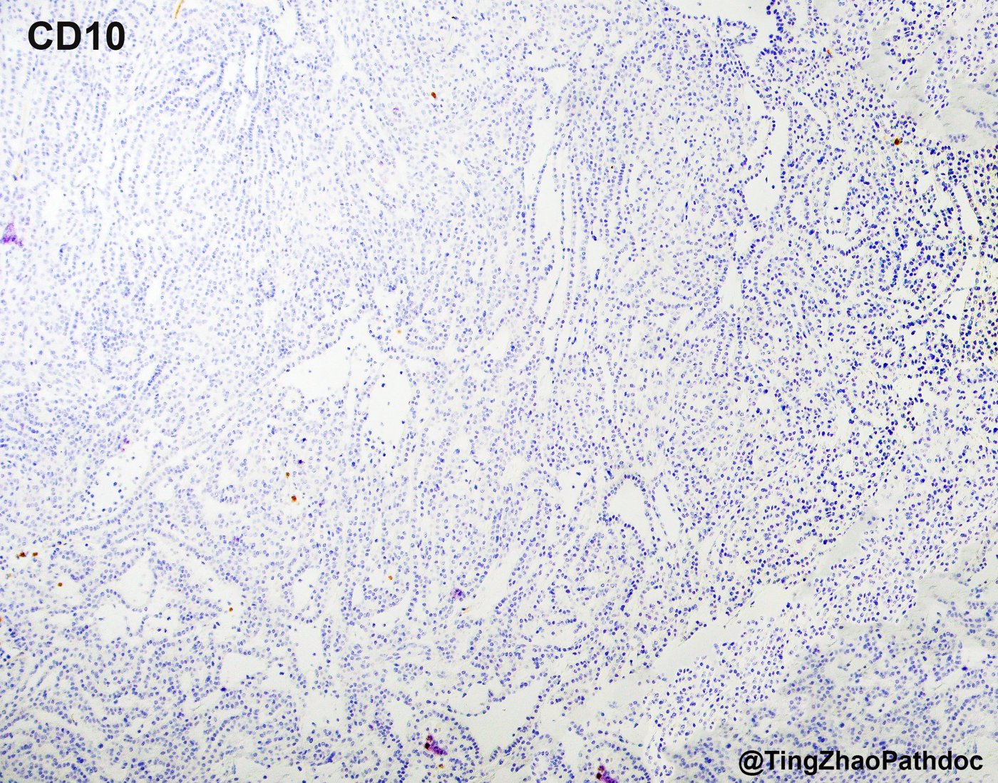 Mucinous tubular and spindle cell carcinoma: CD10: negative in the tumour cells