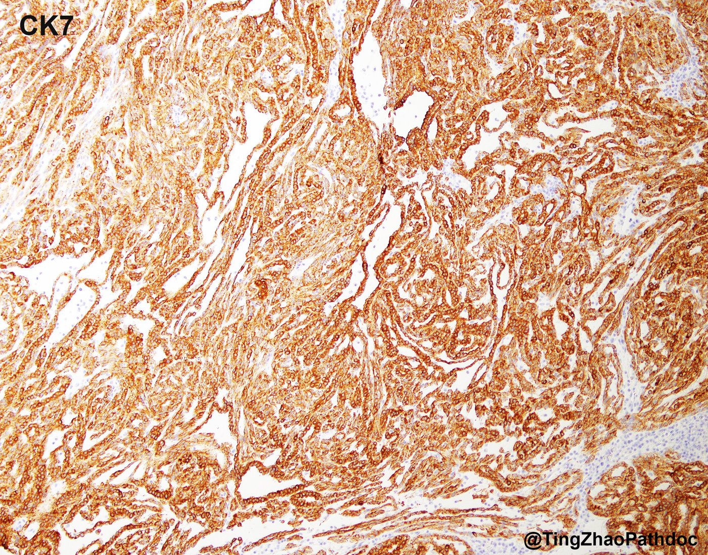 Mucinous tubular and spindle cell carcinoma: CK7: diffuse strong positivity in tubules and spindled cords