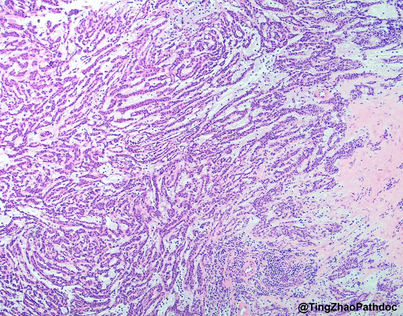 Mucinous tubular and spindle cell carcinoma: Compressed tubules and cords merging into spindle cell areas; collagenous stroma at right