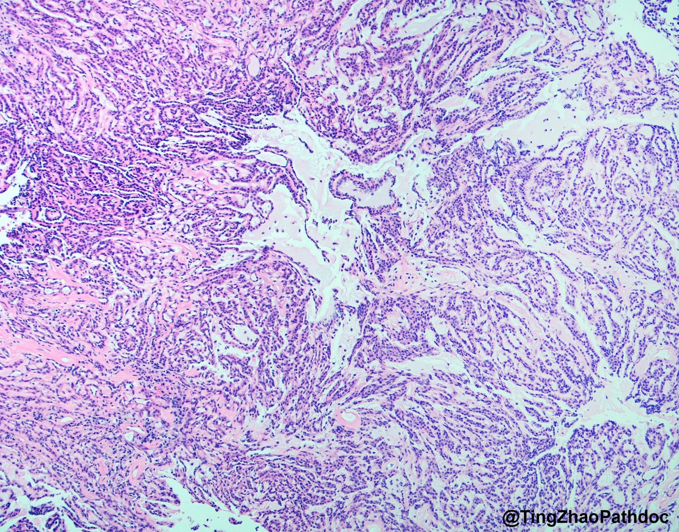 Mucinous tubular and spindle cell carcinoma: Elongated tubules and cords streaming through pale myxoid stroma