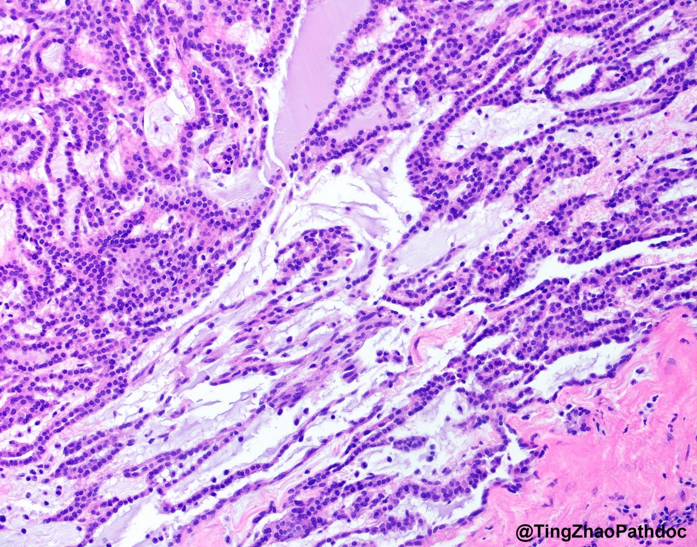 Mucinous tubular and spindle cell carcinoma: Bland tubules transitioning to spindle cells in blue-grey mucinous matrix
