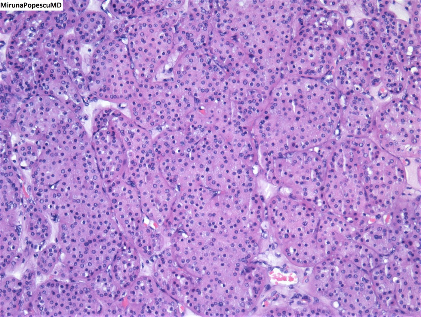 Oncocytoma of the kidney — Nests of oncocytic cells with round, uniform nuclei