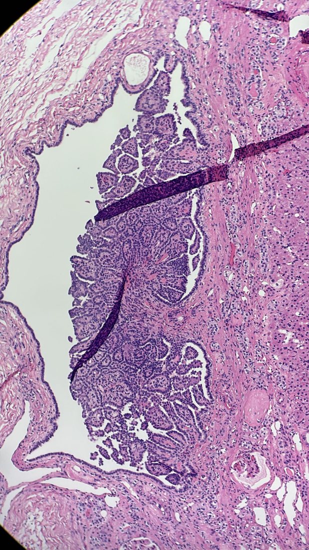 Renal papillary adenoma — Tubulopapillary proliferation protruding into a cystic space
