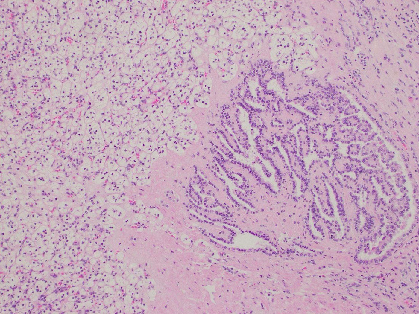 Renal papillary adenoma — Papillary adenoma (right) next to clear cell RCC (left)