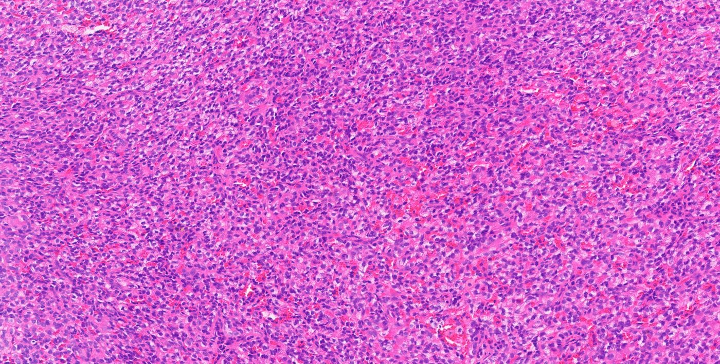 Papillary renal cell carcinoma — Solid / compact growth with inconspicuous papillae