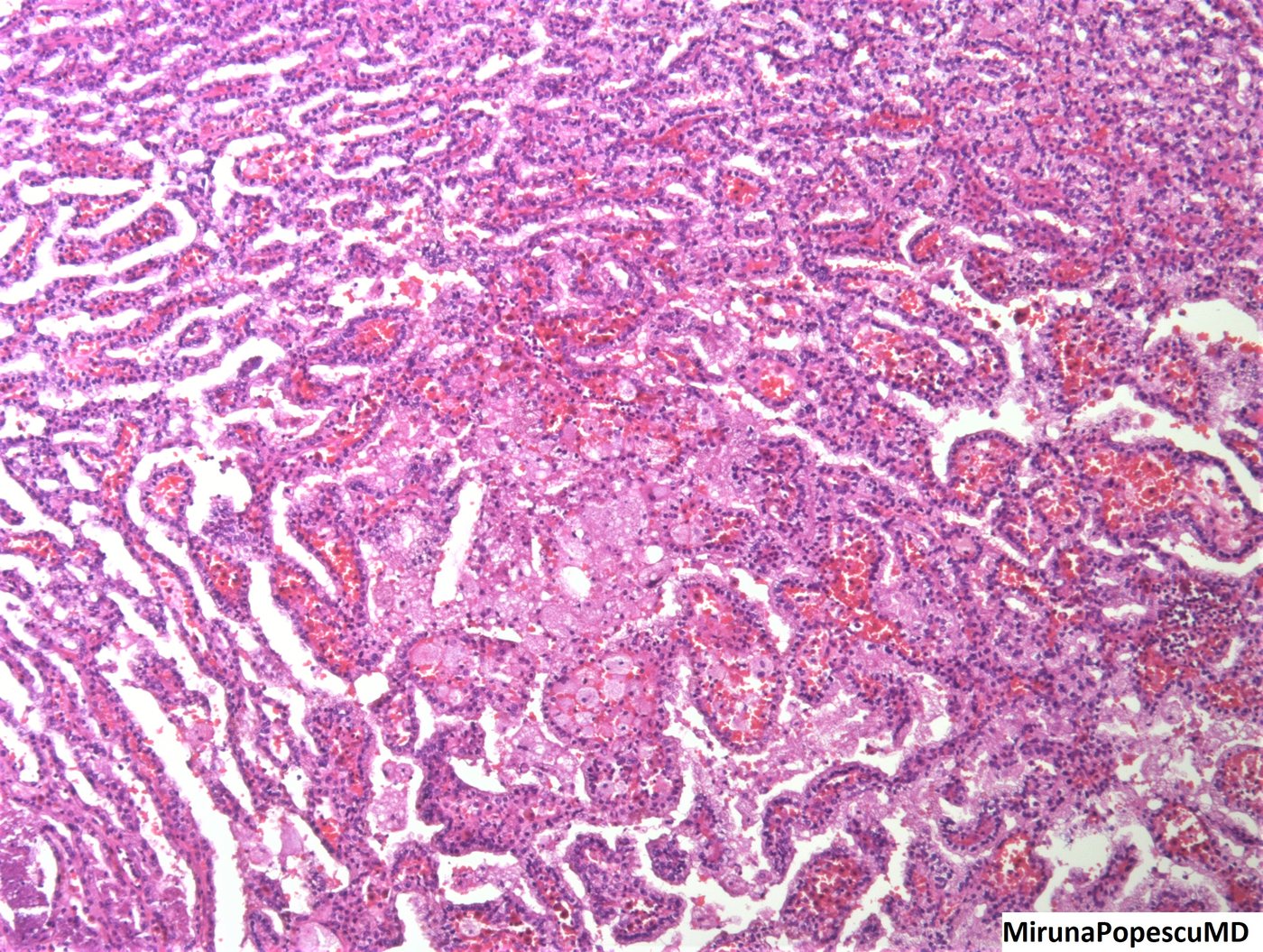 Papillary renal cell carcinoma — Papillae with foamy macrophages and haemorrhage in the cores
