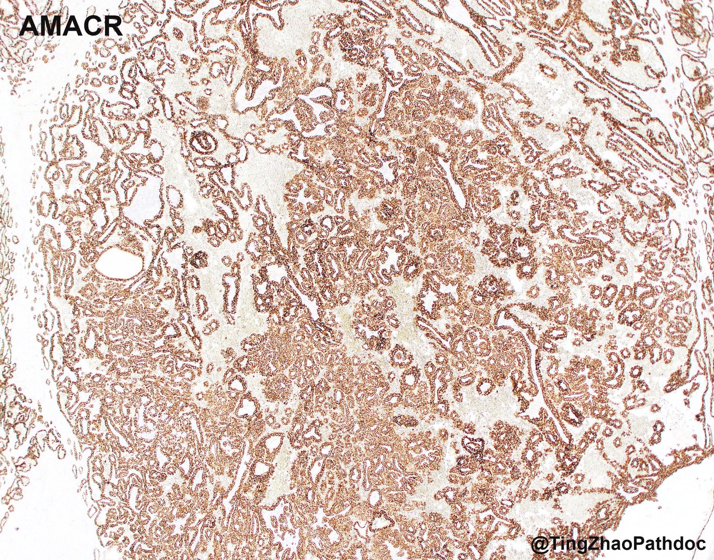 Papillary renal cell carcinoma — AMACR: diffuse, strong