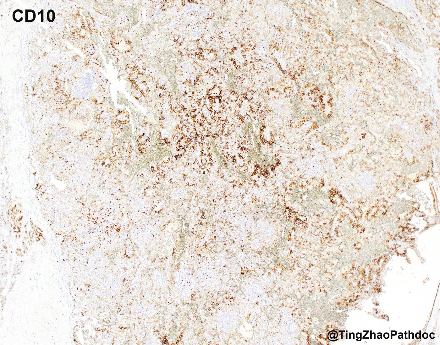 Papillary renal cell carcinoma — CD10: patchy, predominantly luminal